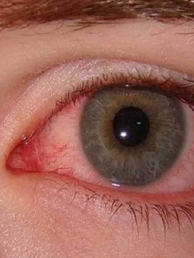 आई फ्लू क्या है जो तेजी से फैल रही है। जानिये इसके लक्षणों और इससे बचाने का सटीक उपाय